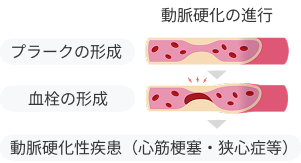 動脈硬化の進行 プラークの形成 血栓の形成 動脈硬化性疾患（心筋梗塞・狭心症等）